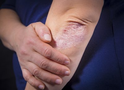 Psoriasis