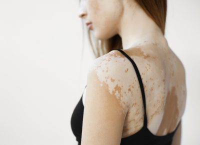 Vitiligo